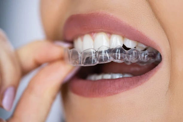 Invisalign or Braces?