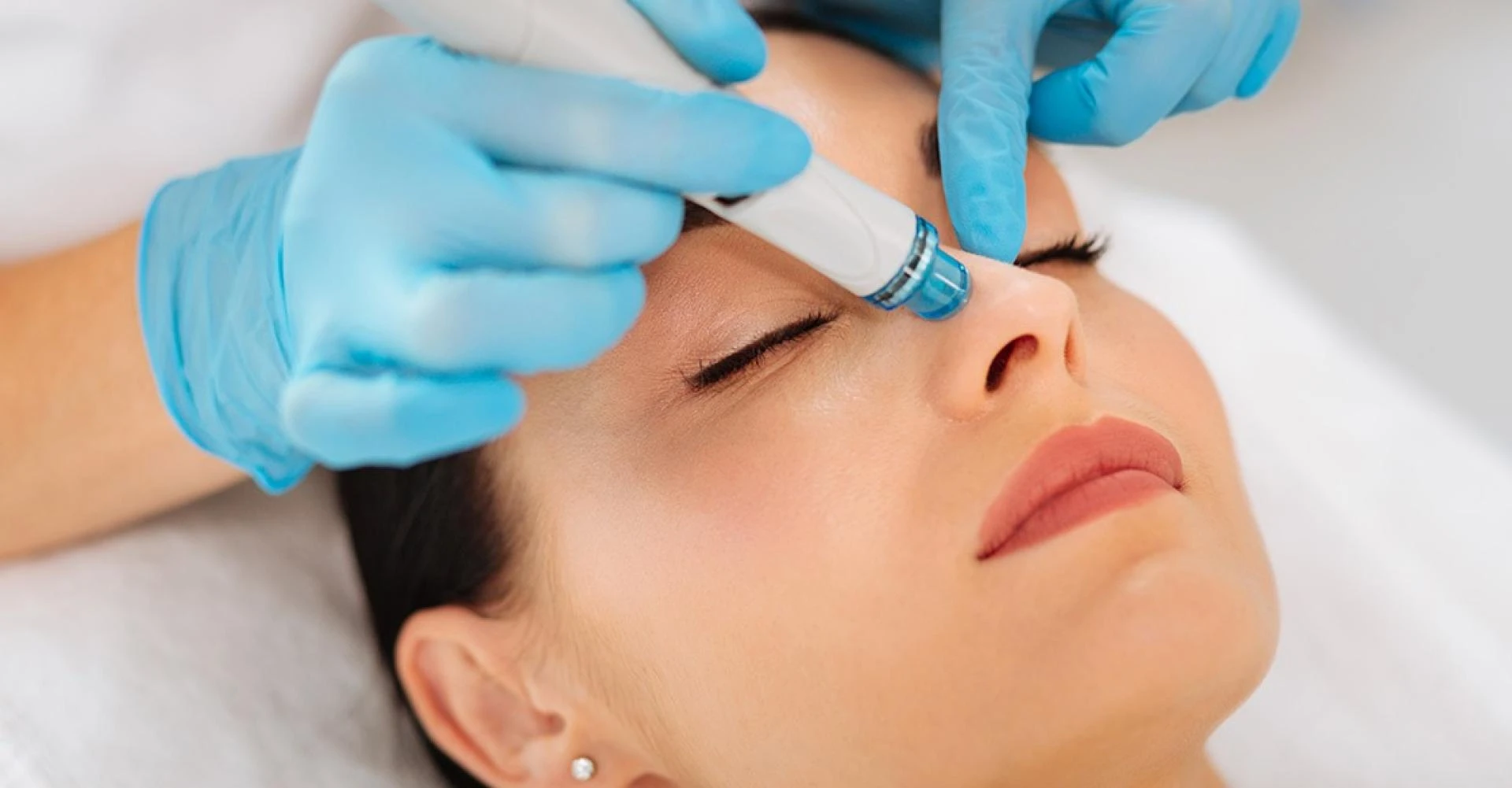 Does Hydrafacial Remove Blackheads Fast?