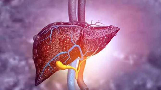 How to Prevent Fatty Liver Naturally Through Ayurvedic Herbs