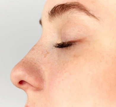 Common Side Effects After Rhinoplasty in Islamabad & How to Manage Them