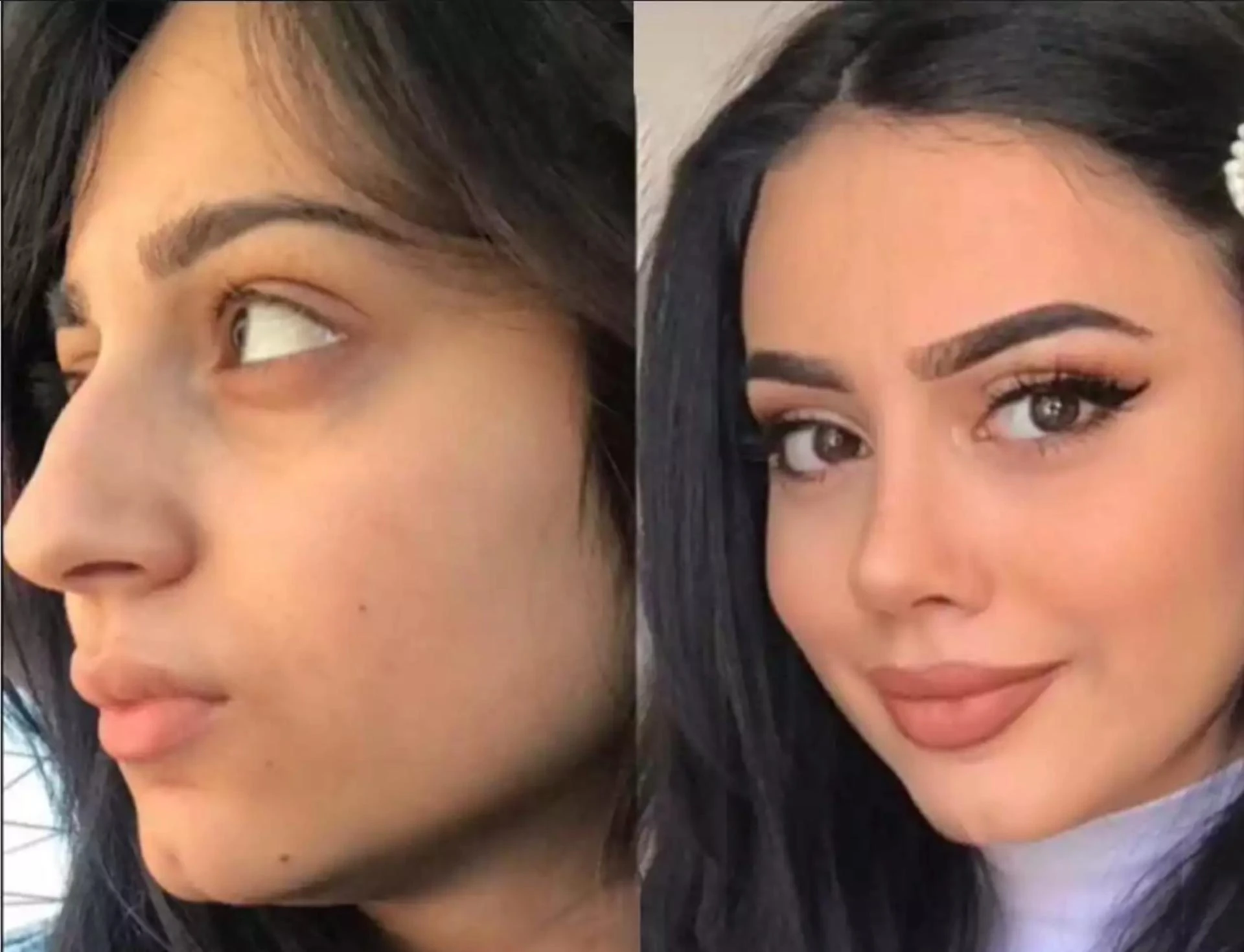 Can the Best Rhinoplasty Surgeon in Dubai Ensure Natural Results?