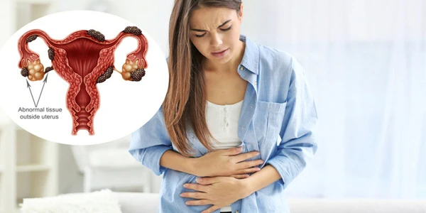 Food to Eat and Avoid If You Have Endometriosis