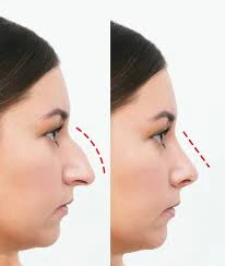 Is rhinoplasty in Riyadh painful? A detailed answer.