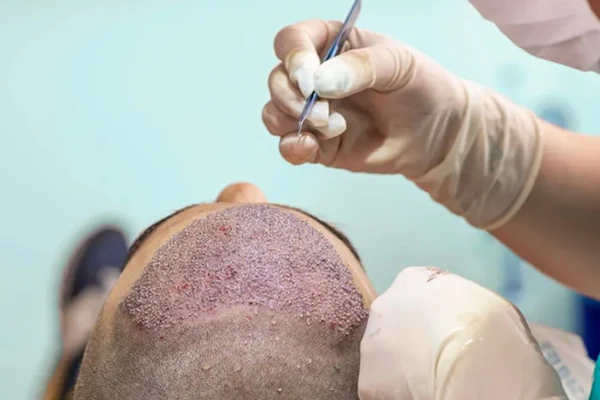 Hair Restoration in Dubai: A Detailed Look at the Transplant Procedure