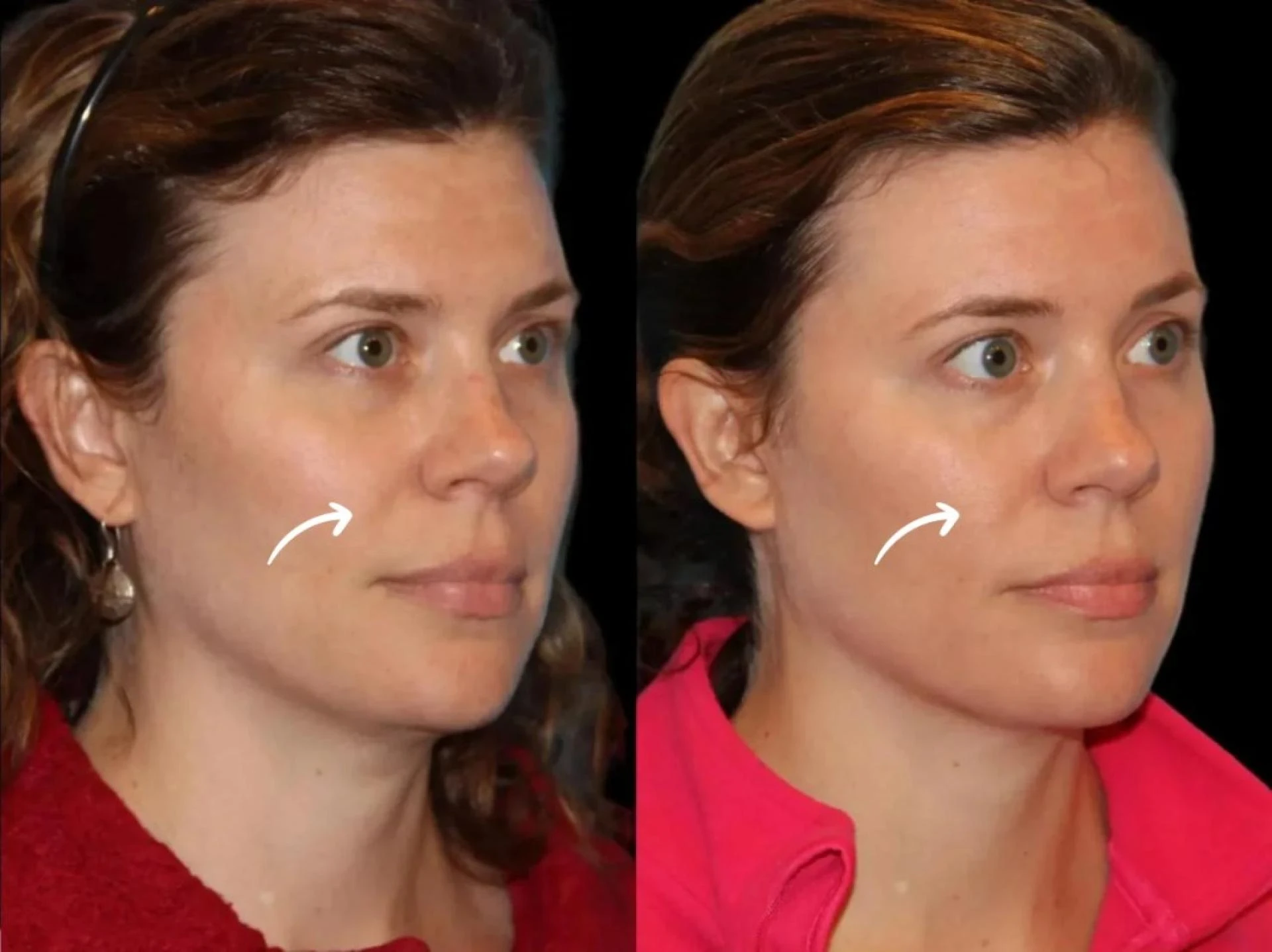 Best Plastic Surgeons in Dubai explain Sculptra logic