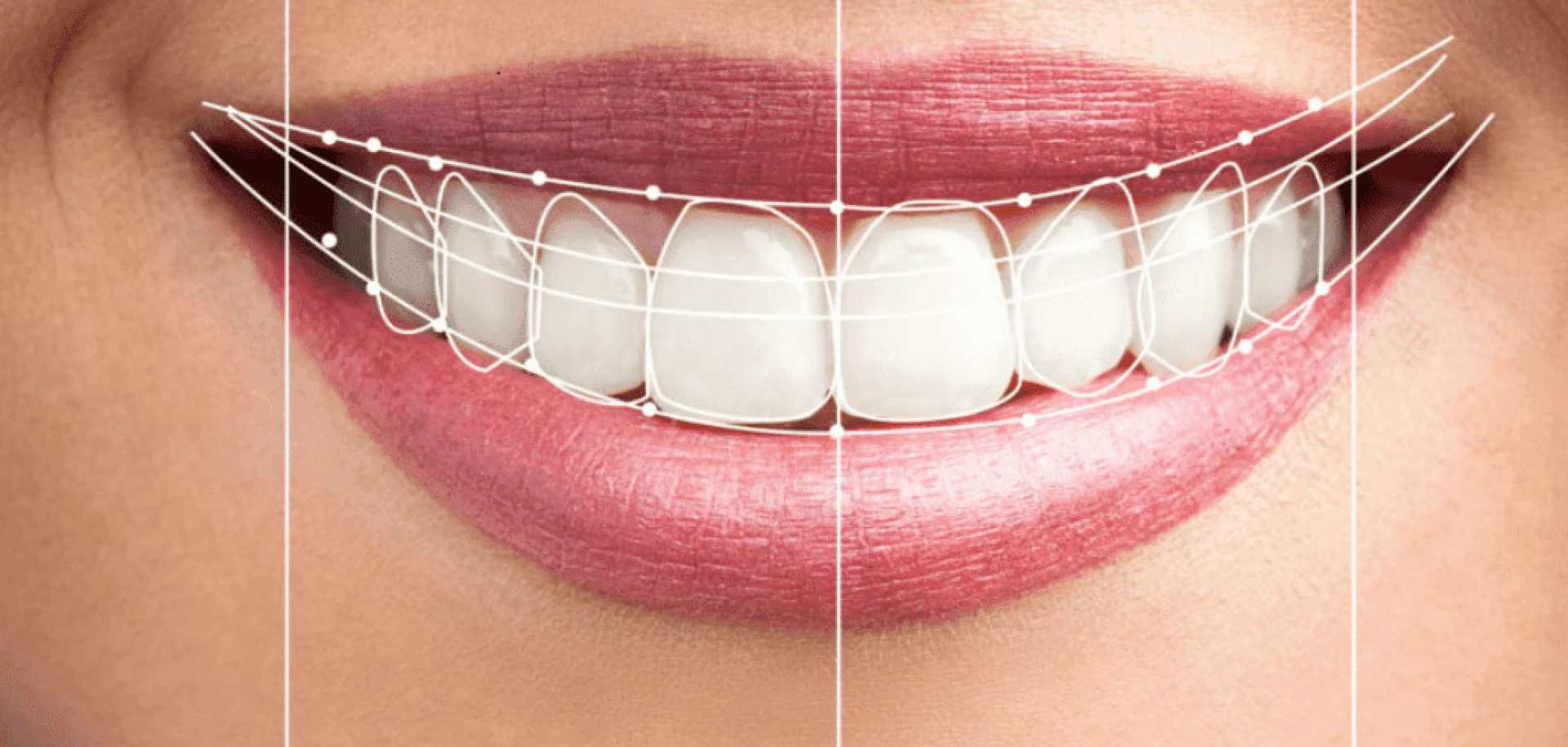 Digital Smile Design Dubai: Create Your Dream Smile with Precision