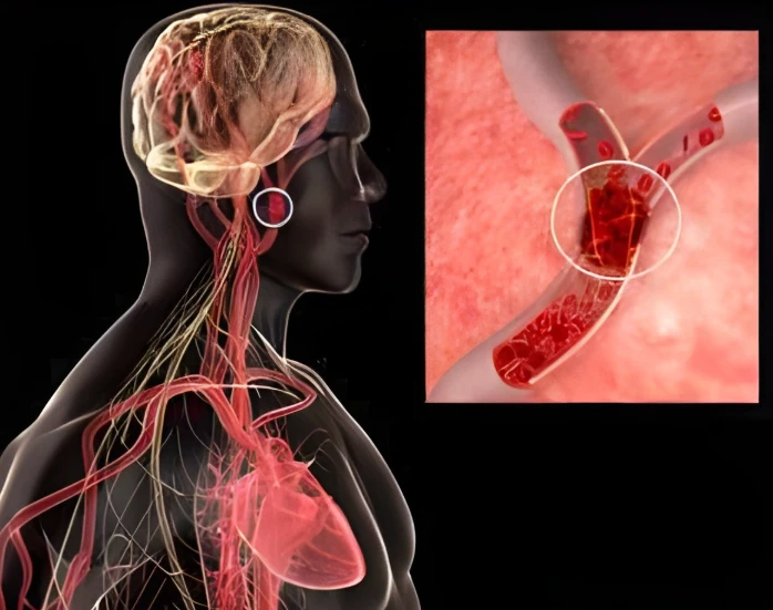 Heart Disease in Women: Detecting Risk Early with Genetic Testing in NYC