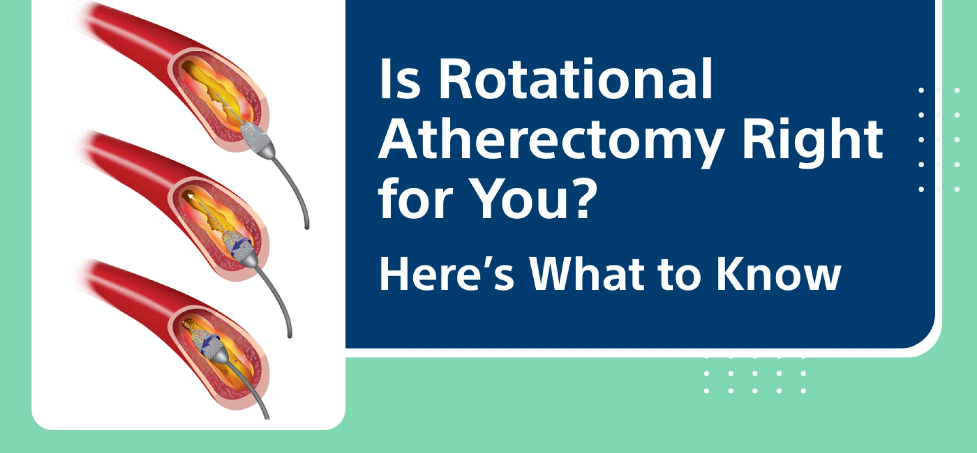 Is Rotational Atherectomy Right for You? Here’s What to Know