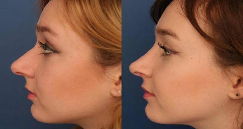Rhinoplasty in Riyadh: A Comprehensive Comparison of Surgical and Non-Surgical Solutions