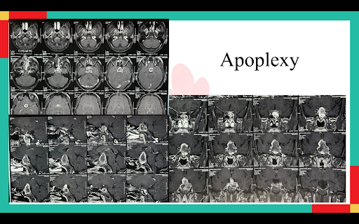 78-Year-Old Woman Miraculously Recovers from a Brain Condition That Mimics Electric Shocks | A Case in Trigeminal Neuralgia