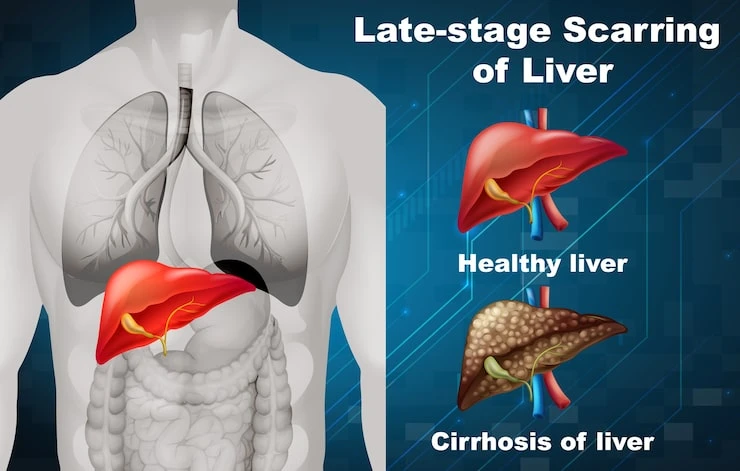 Liver Transplant in India: A Complete Guide to Cost, Hospitals & Recovery