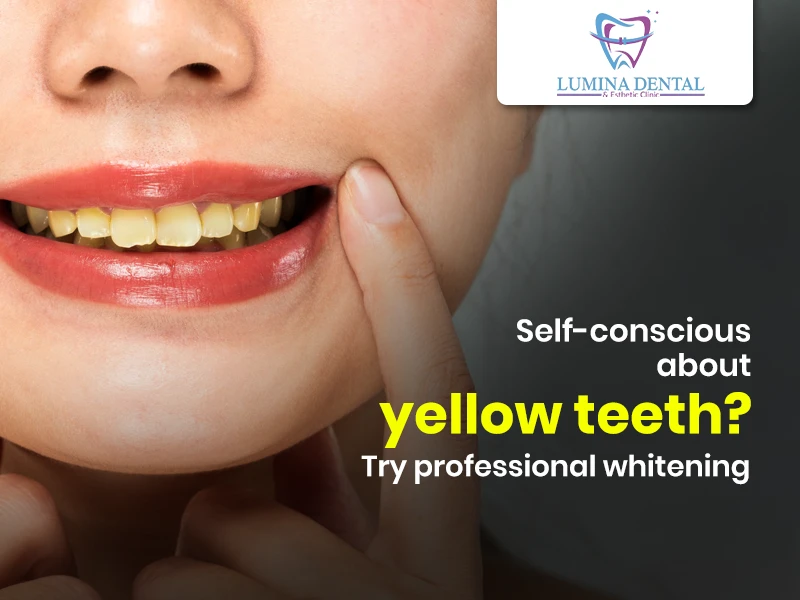 Brighten Your Smile with Professional Teeth Whitening at Lumina Dental and Esthetic Clinic
