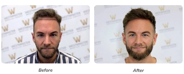 Hair Transplant vs Non-Surgical Options: Which Is Better for You?