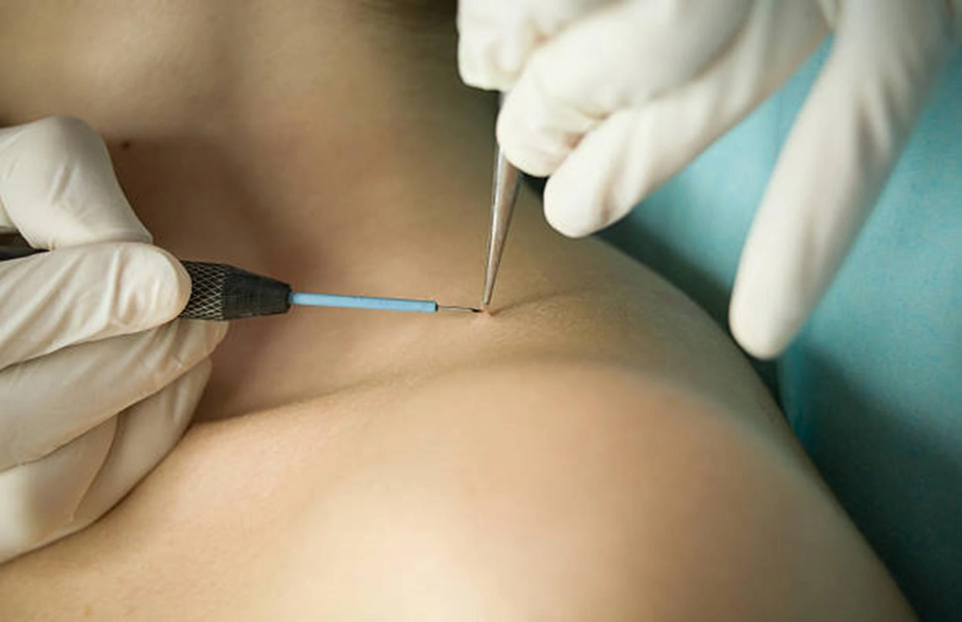 How Quickly Does Warts Removal Treatment Heal?