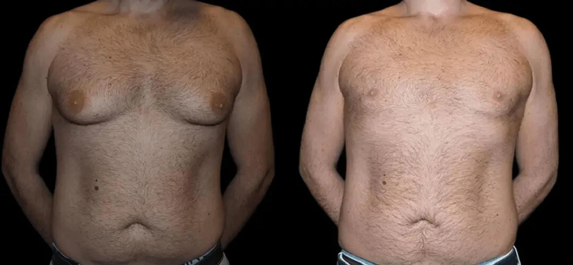 Gynecomastia Surgery in dubai for a Fit, Sculpted, and Defined Chest
