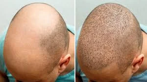 The Ultimate Guide to Hair Transplant Procedures in Riyadh