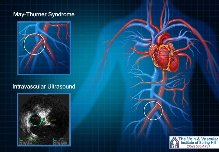 Why Early Detection of May-Thurner Syndrome Matters in Santa Fe
