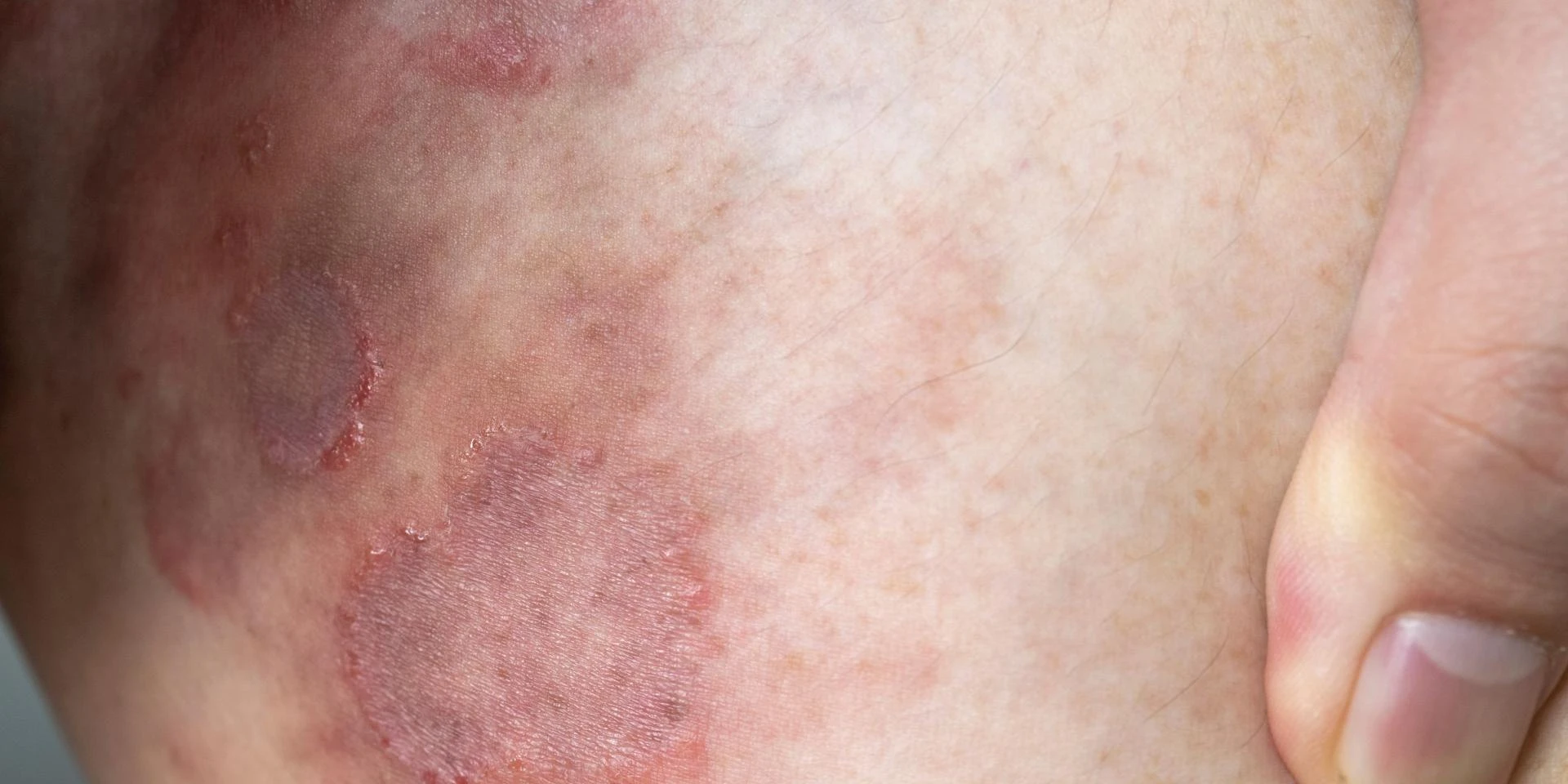 How to Prevent Ringworm Infections at Home and School