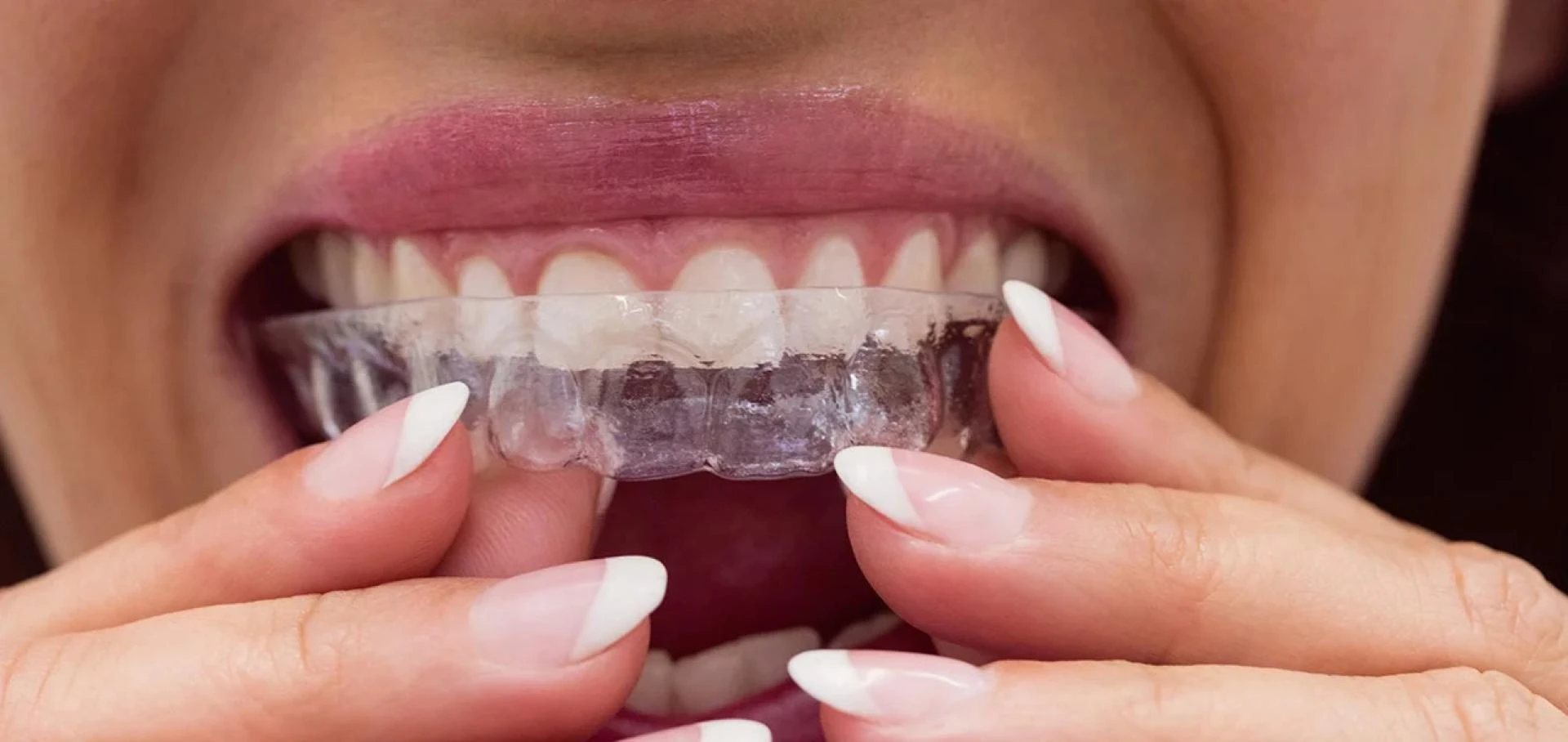 The Dental Roots’ Simple Stepwise Process for Clear Aligners in India Patients.
