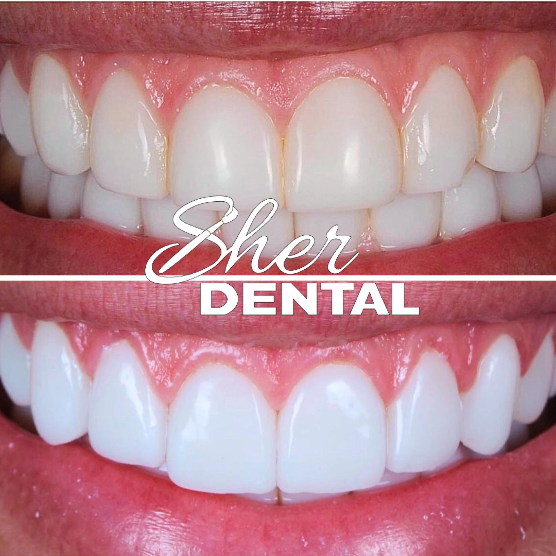 What Veneers Can Fix: Chips, Gaps, Discoloration, and Uneven Teeth
