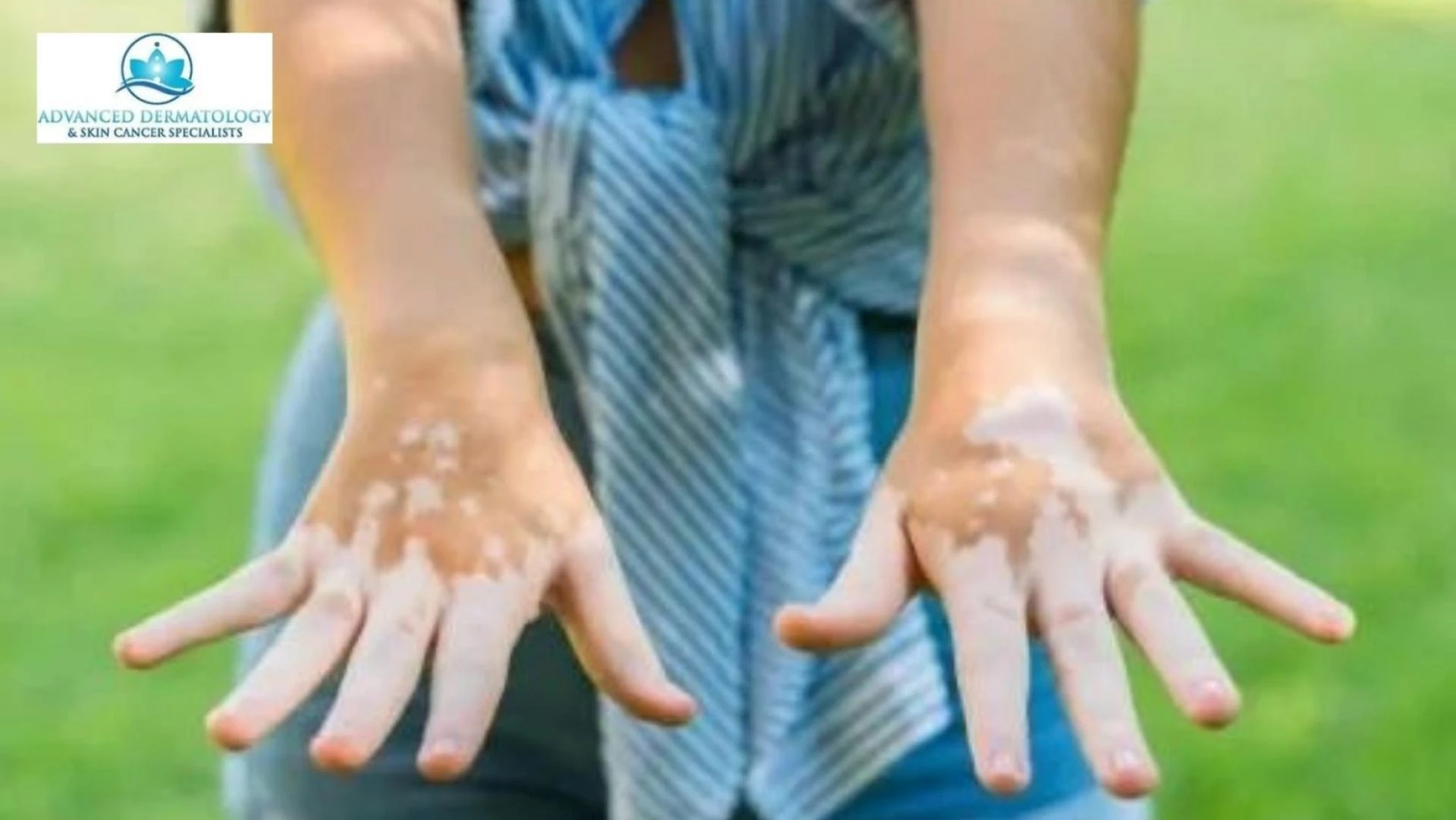 Is Fingernail Lifting a Sign of Infection or Just Nail Damage?