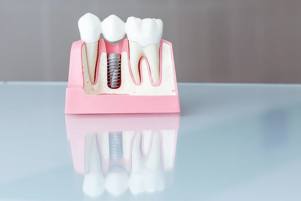 Why Are Dental Implants in Miami Considered a Reliable Solution?