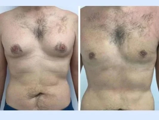 Treatment Options Suggested by the Best Gynecomastia Surgeons in Dubai