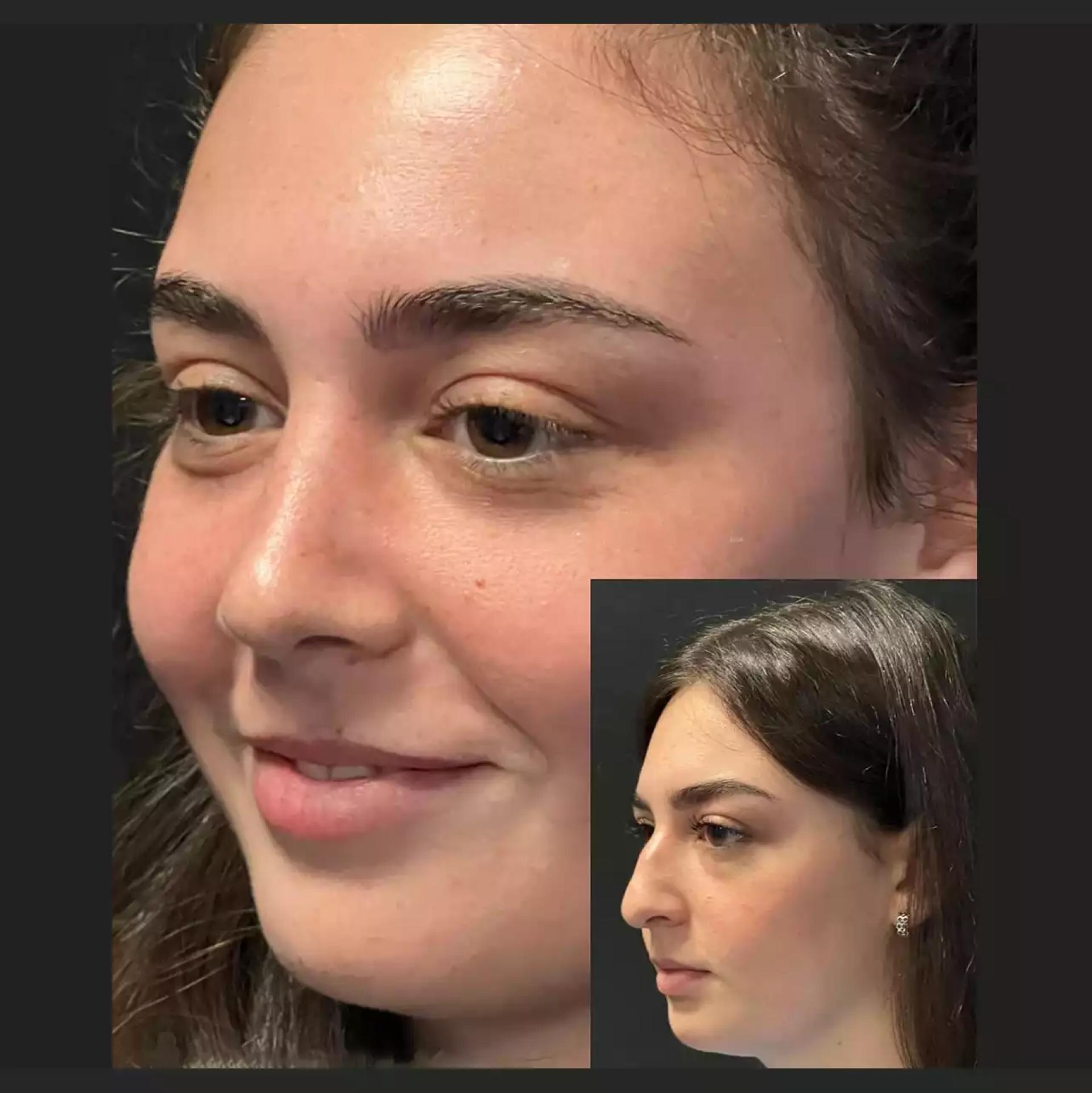 Rhinoplasty in Dubai: Blending Science, Art, and Technology