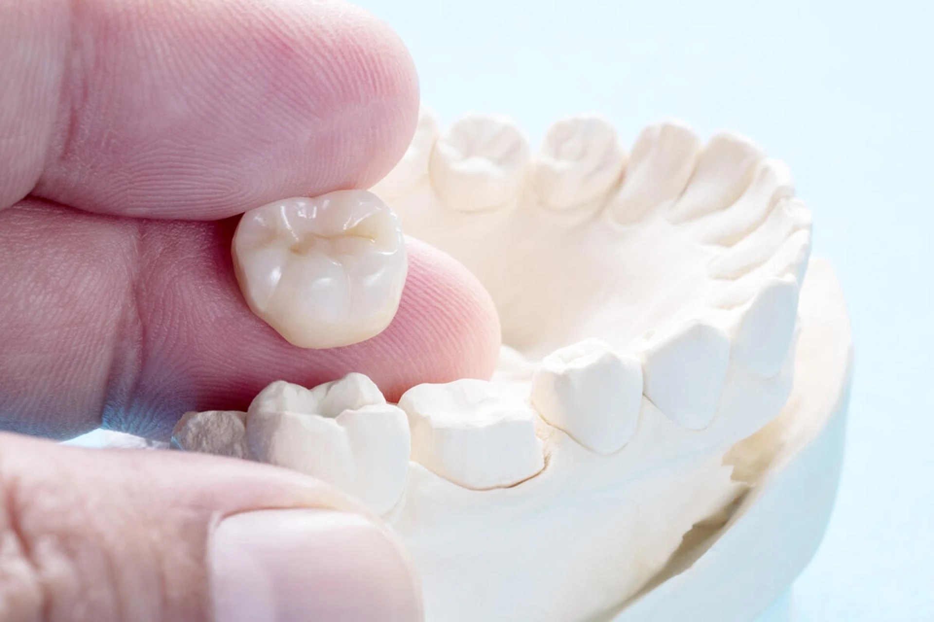 8 Things You Wouldn’t Like to Miss About Dental Crowns