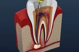 What Does Root Canal Therapy Do?