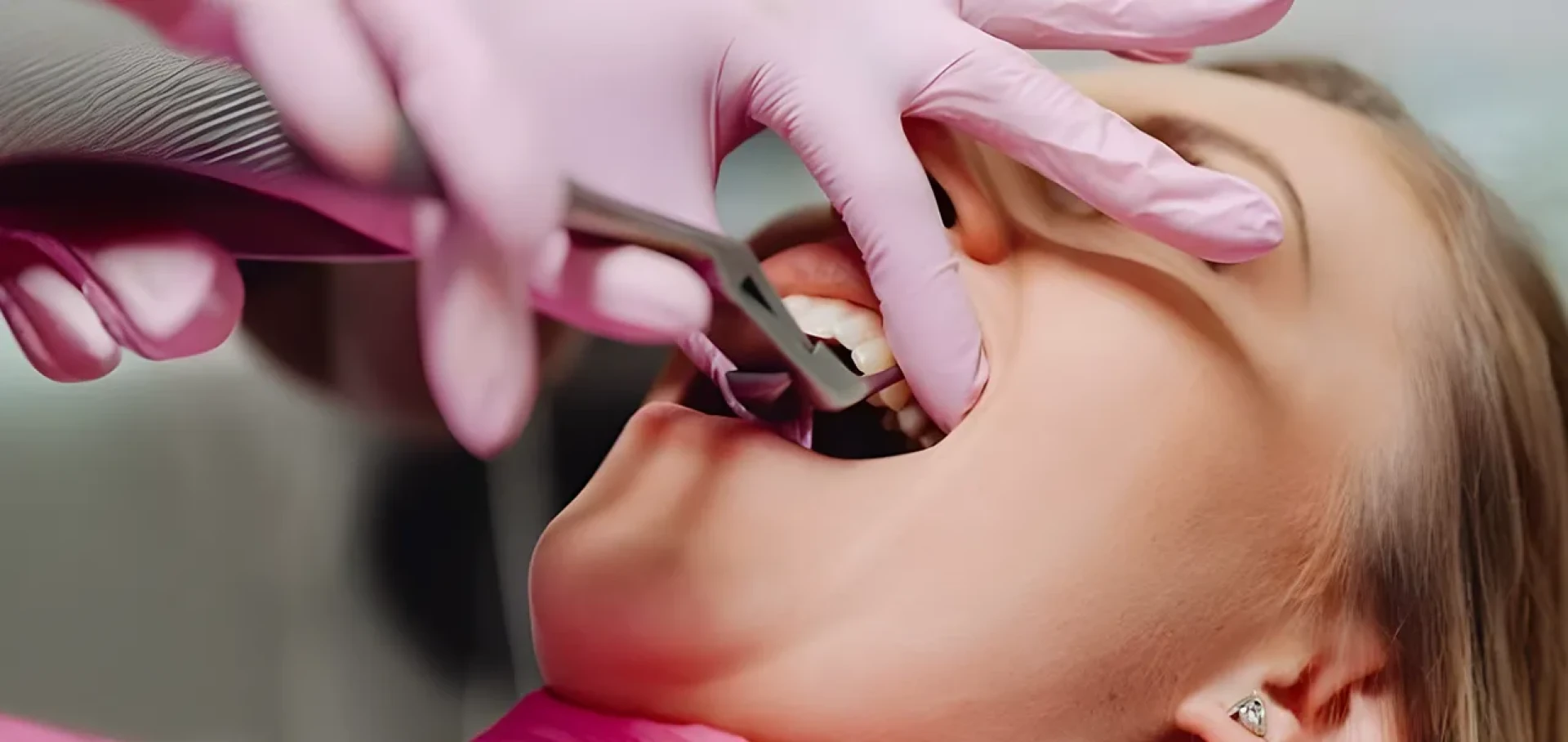 The Dental Roots Specialists for Complicated Wisdom Tooth Extraction Delhi.