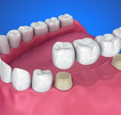 Services for Dental Bridges: Types and Strategies to Make Them Last