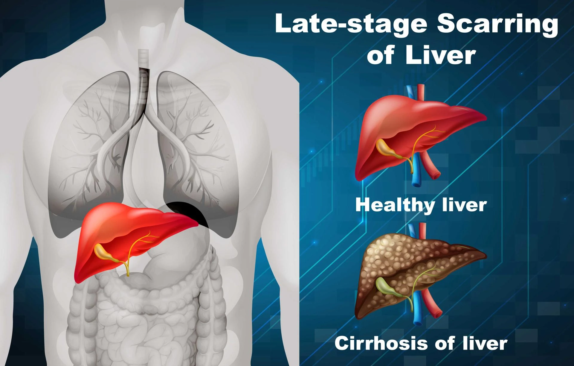 Liver Cirrhosis Treatment in India: Expert Picks & Price Guide 