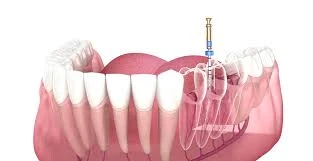 Why Root Canal Treatment Is a Smart Choice for Saving Your Natural Tooth