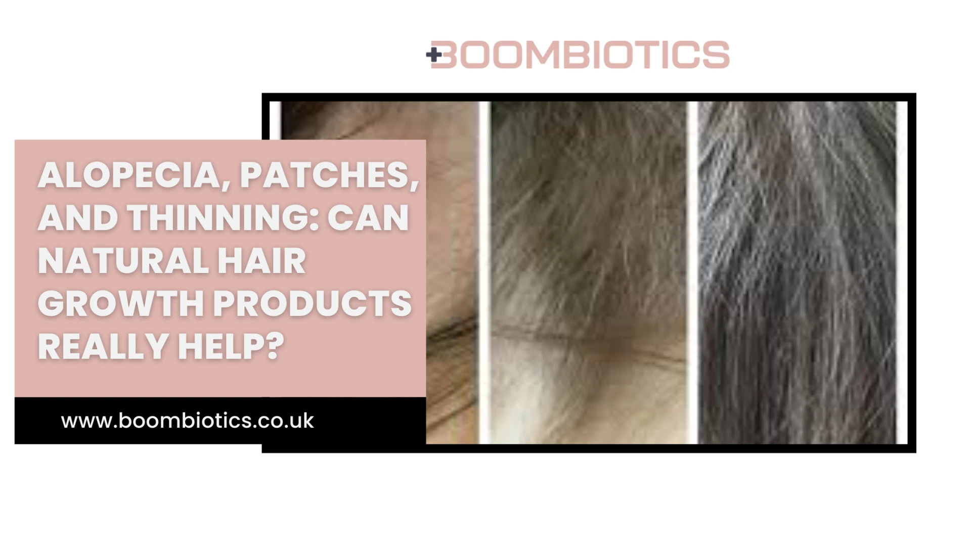 Alopecia, Patches, and Thinning: Can Natural Hair Growth Products Really Help?