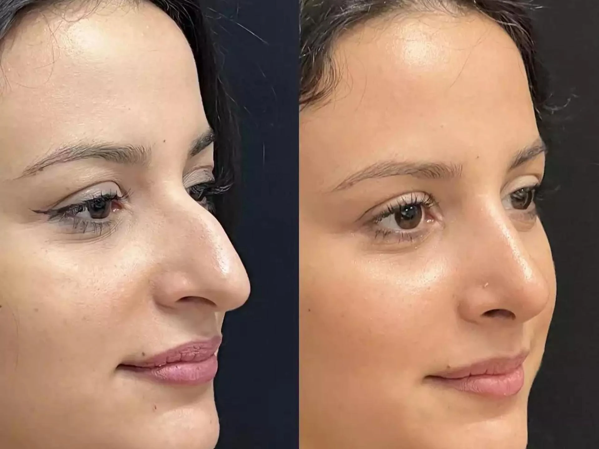 Rhinoplasty in Dubai: Enhancing Looks, Improving Lives