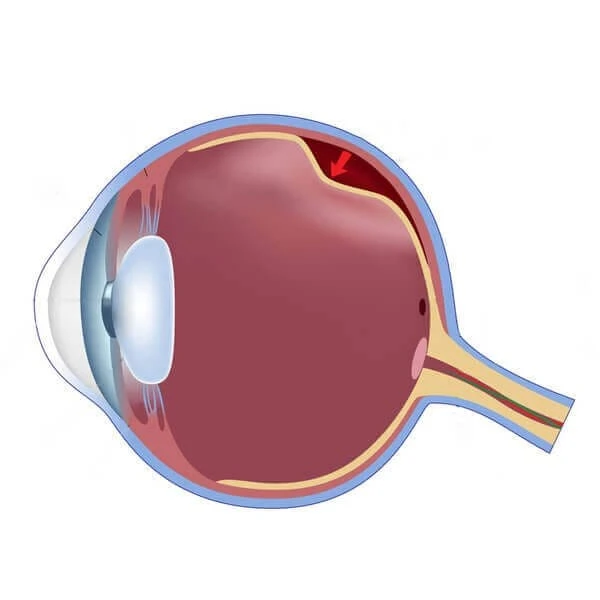 Understanding Retinal Detachment Surgery: A Complete Guide