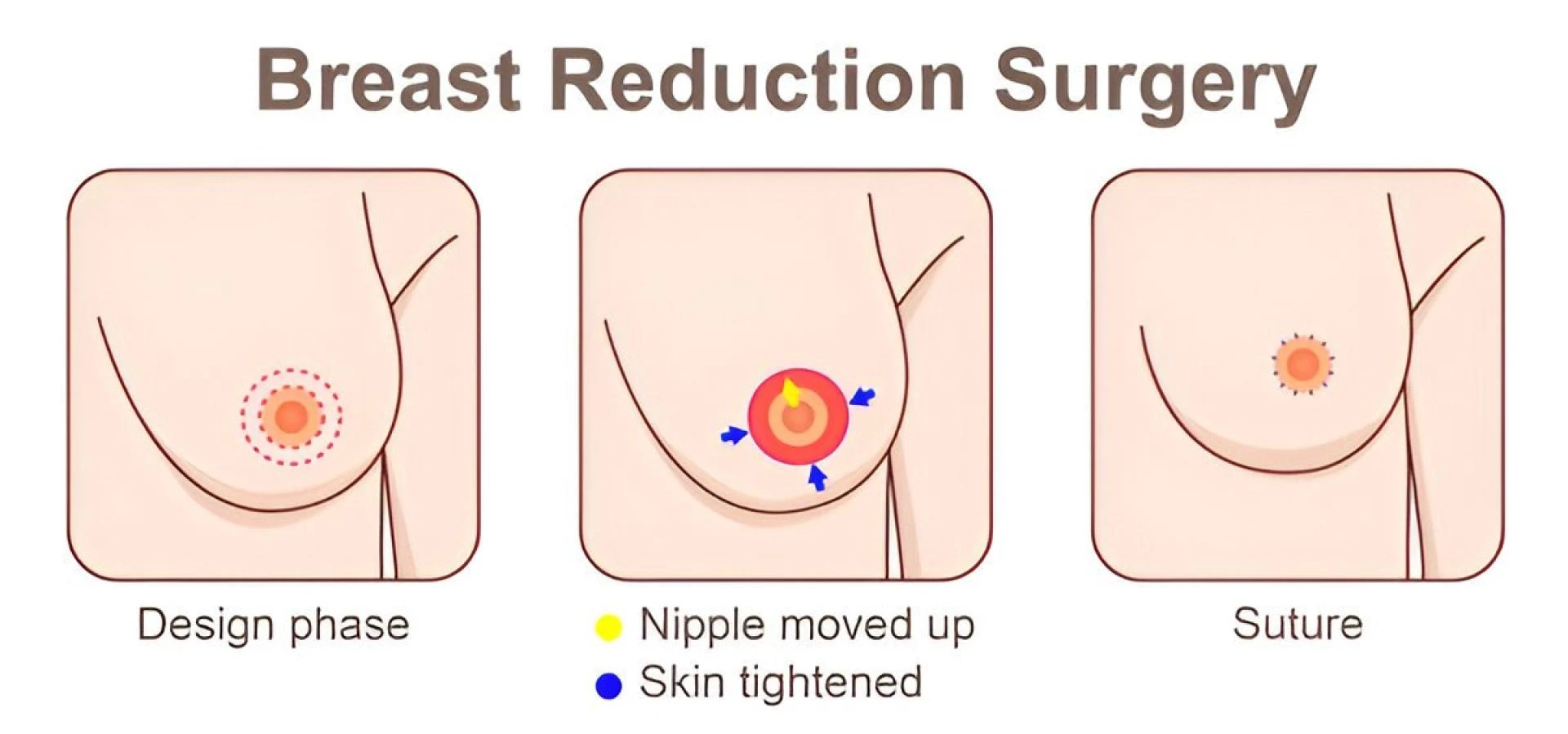 Post-Breast Reduction Care: What to Expect During Recovery