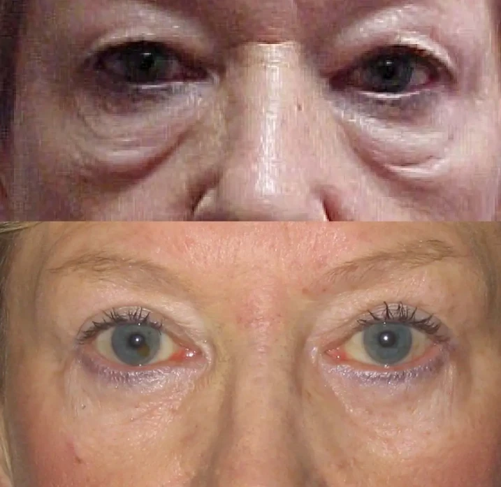 A Complete Guide to Lower Blepharoplasty in Cape Town