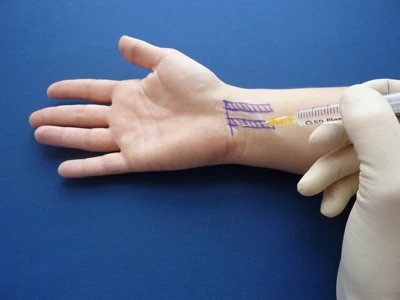 Understanding Carpal Tunnel Injections | A Comprehensive Guide to Relief and Recovery