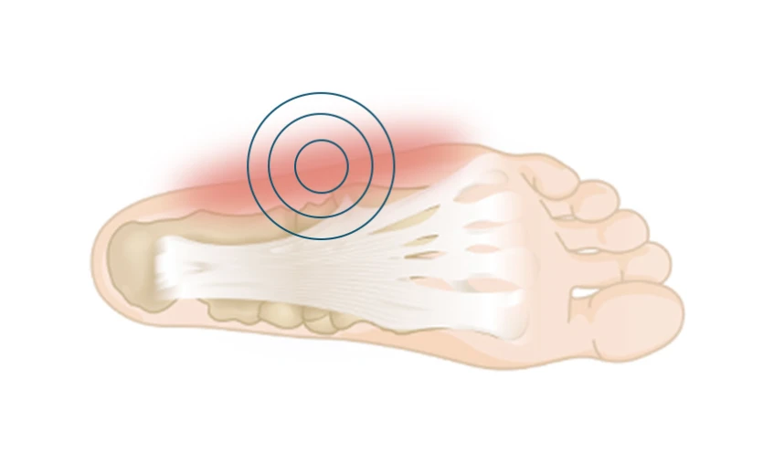 Why Shoe Inserts Insoles Are Essential for Pain-Free Walking