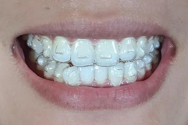 8 Invisalign Secrets That Make Your Smile Journey Easier