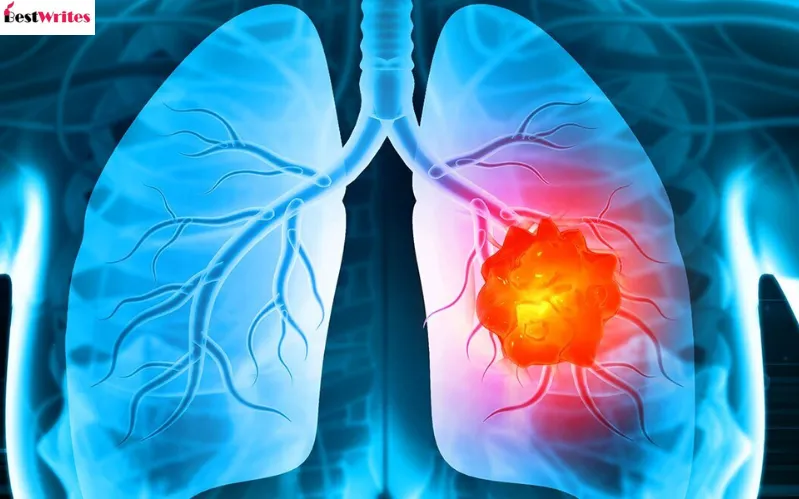 Lung Cancer Screening ICD-10 Codes: What You Must Know | Best Writes Links
