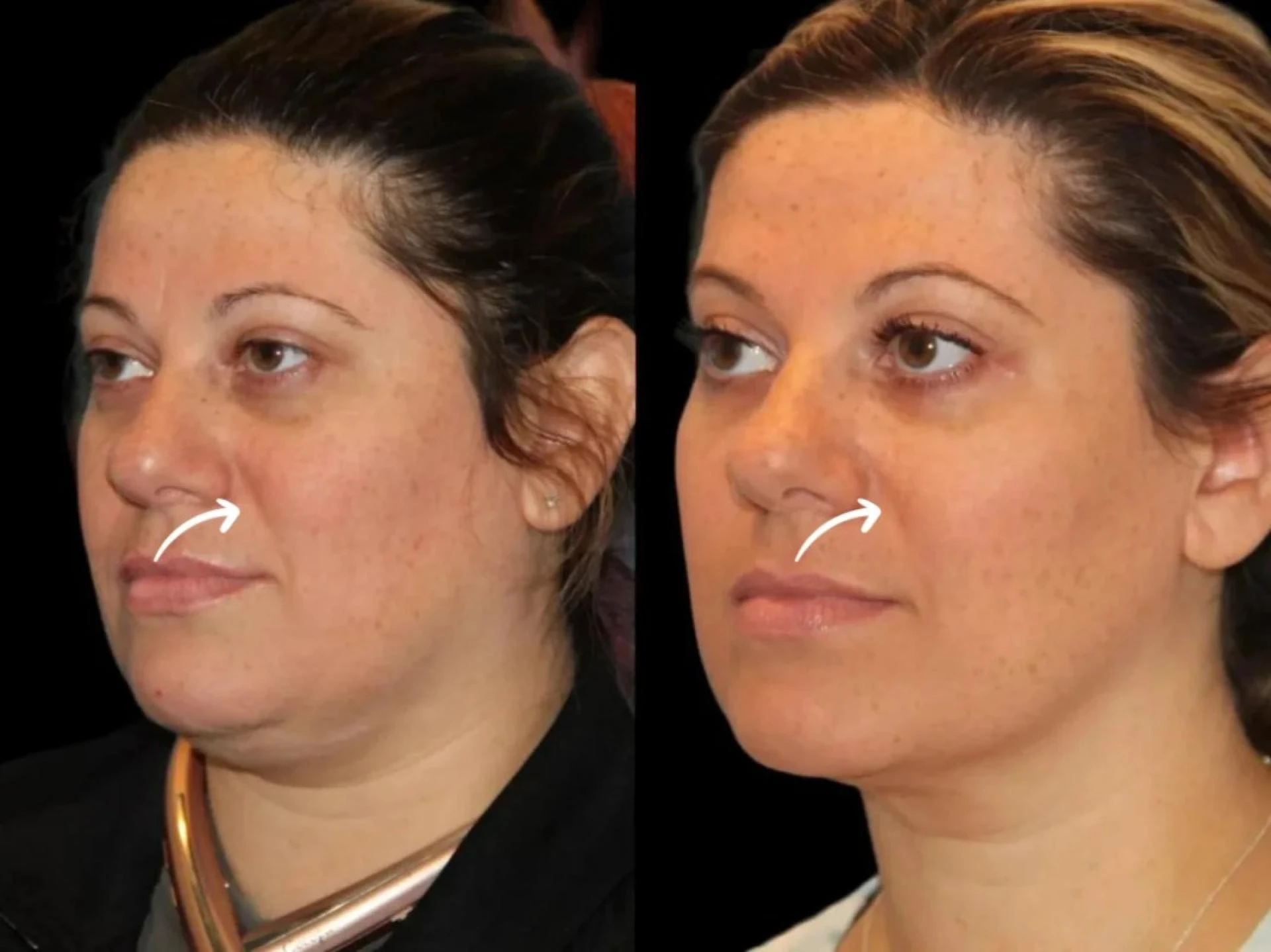 Best Aesthetic Clinics in Dubai: Sculptra Tested