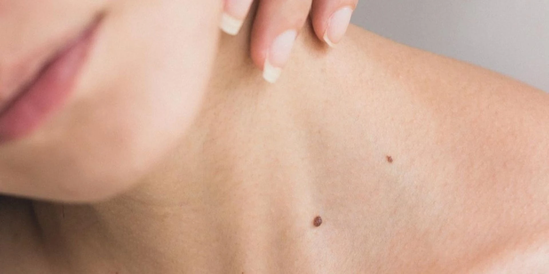 Why SRT Skin Cancer Treatment is the Best Way to Help You Heal?