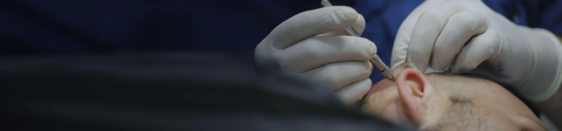 Afro Hair Transplant in Turkey Explained: The Science Behind Natural Results