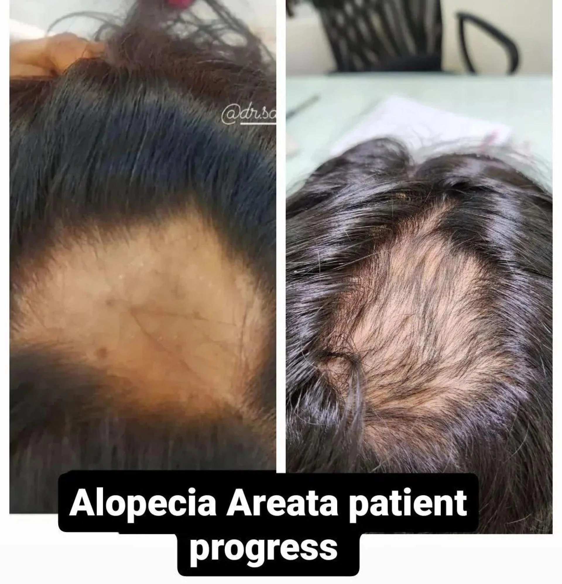 From Laser Therapy to PRP: Best Hair Fall Treatment at Skin & Laser Clinic in Bhopal