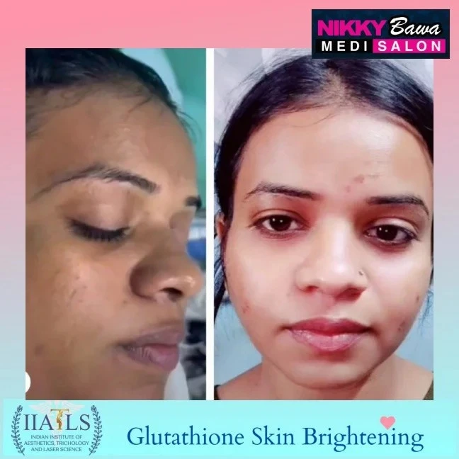 Best Skin Care Clinic Bhopal Madhya Pradesh for Glutathione Skin Whitening treatment
