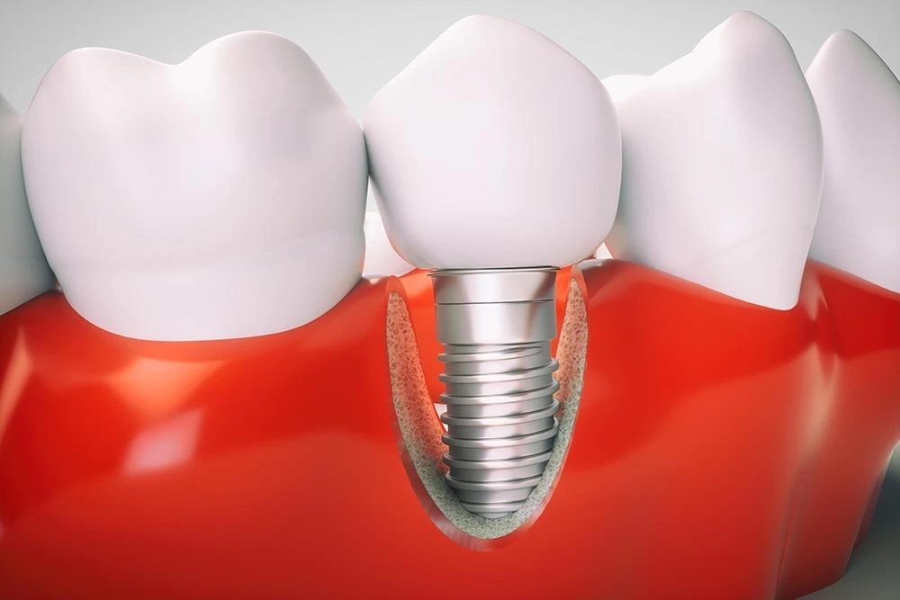 7 Mistakes After Getting Dental Implants