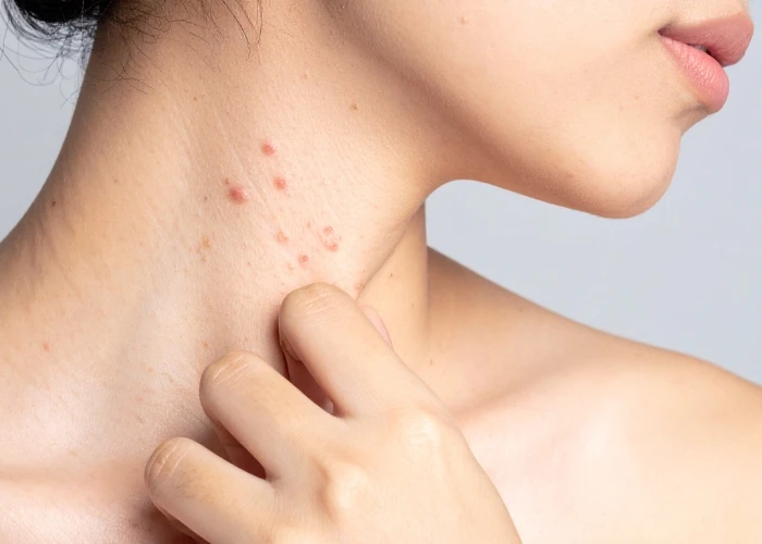Common Causes of Skin Rashes in Richmond – Lifecare Primary Medical Insights
